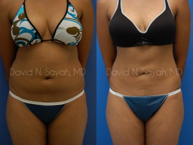Liposuction Before and After | Sayah Institute