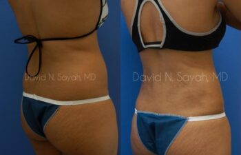 Liposuction Before and After | Sayah Institute