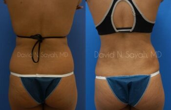Liposuction Before and After | Sayah Institute