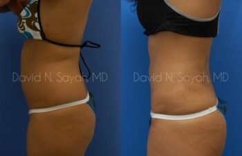 Liposuction Before and After | Sayah Institute