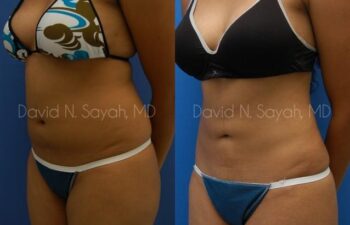 Liposuction Before and After | Sayah Institute