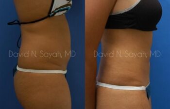 Liposuction Before and After | Sayah Institute