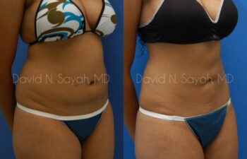 Liposuction Before and After | Sayah Institute