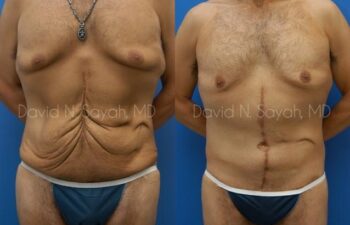 Scar Revision Body Before and After | Sayah Institute
