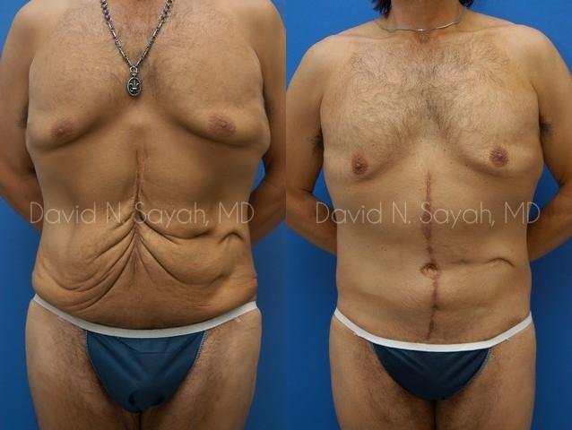 Scar Revision Body Before and After | Sayah Institute