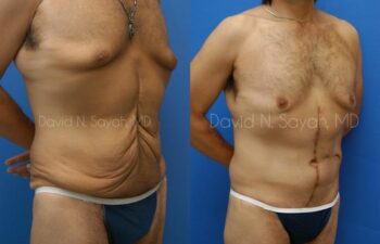 Scar Revision Body Before and After | Sayah Institute