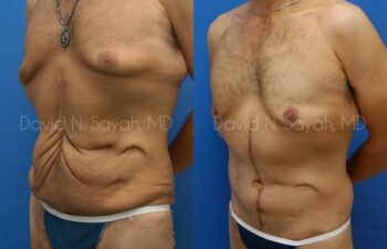 Scar Revision Body Before and After | Sayah Institute