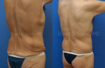 Scar Revision Body Before and After | Sayah Institute