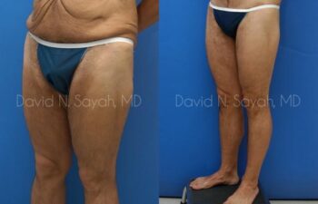 Scar Revision Body Before and After | Sayah Institute