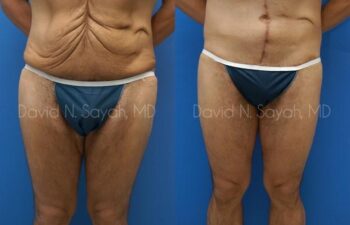 Scar Revision Body Before and After | Sayah Institute