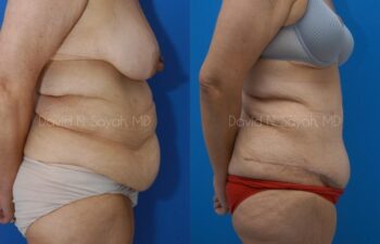 Body Lift Before and After | Sayah Institute