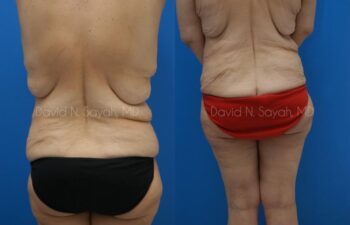 Body Lift Before and After | Sayah Institute