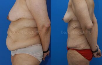 Body Lift Before and After | Sayah Institute