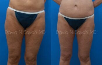 Thigh Lift Before and After | Sayah Institute