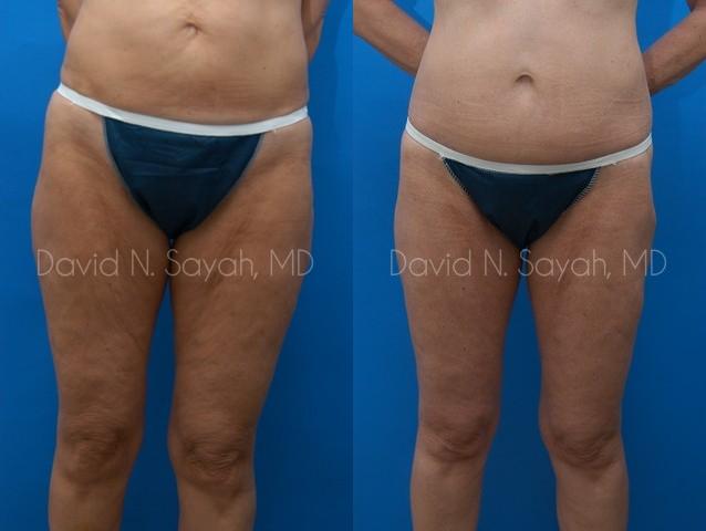 Thigh Lift Before and After | Sayah Institute