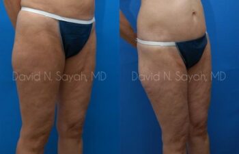 Thigh Lift Before and After | Sayah Institute