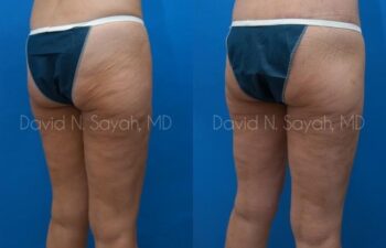 Thigh Lift Before and After | Sayah Institute