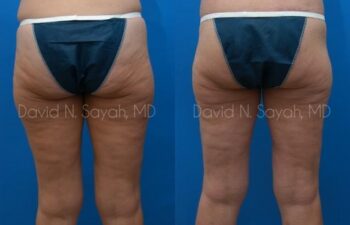 Thigh Lift Before and After | Sayah Institute