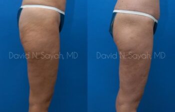 Thigh Lift Before and After | Sayah Institute