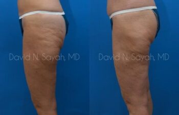 Thigh Lift Before and After | Sayah Institute