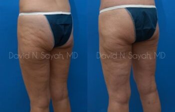 Thigh Lift Before and After | Sayah Institute