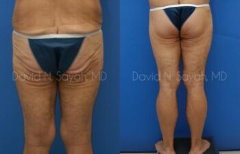 Thigh Lift Before and After | Sayah Institute