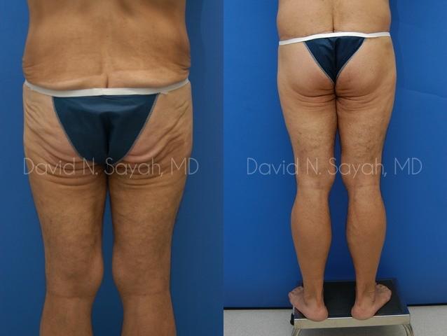 Thigh Lift Before and After | Sayah Institute