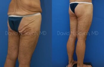 Thigh Lift Before and After | Sayah Institute