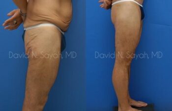 Thigh Lift Before and After | Sayah Institute