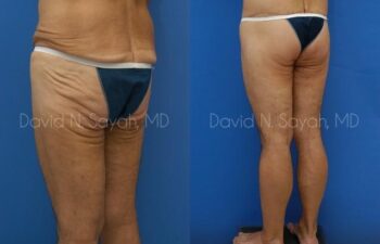 Thigh Lift Before and After | Sayah Institute