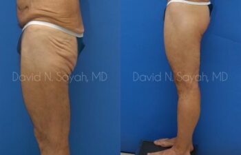 Thigh Lift Before and After | Sayah Institute