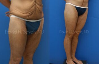 Thigh Lift Before and After | Sayah Institute