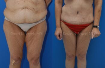 Thigh Lift Before and After | Sayah Institute