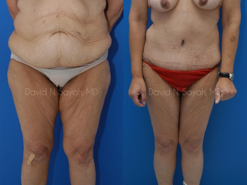 Thigh Lift Before and After | Sayah Institute
