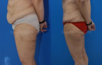 Thigh Lift Before and After | Sayah Institute