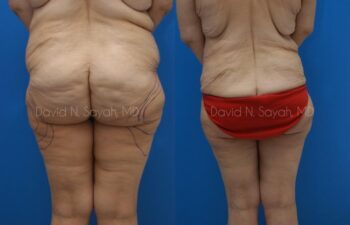 Thigh Lift Before and After | Sayah Institute