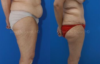 Thigh Lift Before and After | Sayah Institute