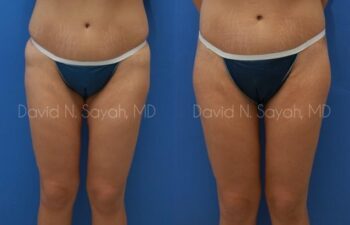 Body Lift Before and After | Sayah Institute