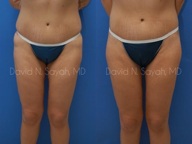 Body Lift Before and After | Sayah Institute