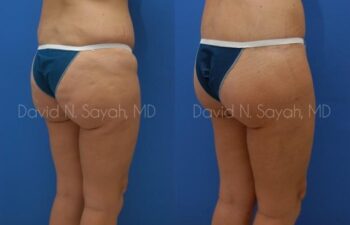 Body Lift Before and After | Sayah Institute