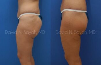 Body Lift Before and After | Sayah Institute