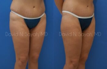 Body Lift Before and After | Sayah Institute