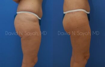 Body Lift Before and After | Sayah Institute