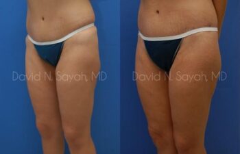 Body Lift Before and After | Sayah Institute