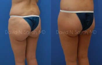 Body Lift Before and After | Sayah Institute
