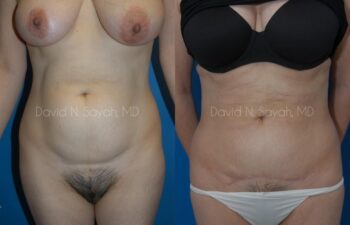 Tummy Tuck Before and After | Sayah Institute