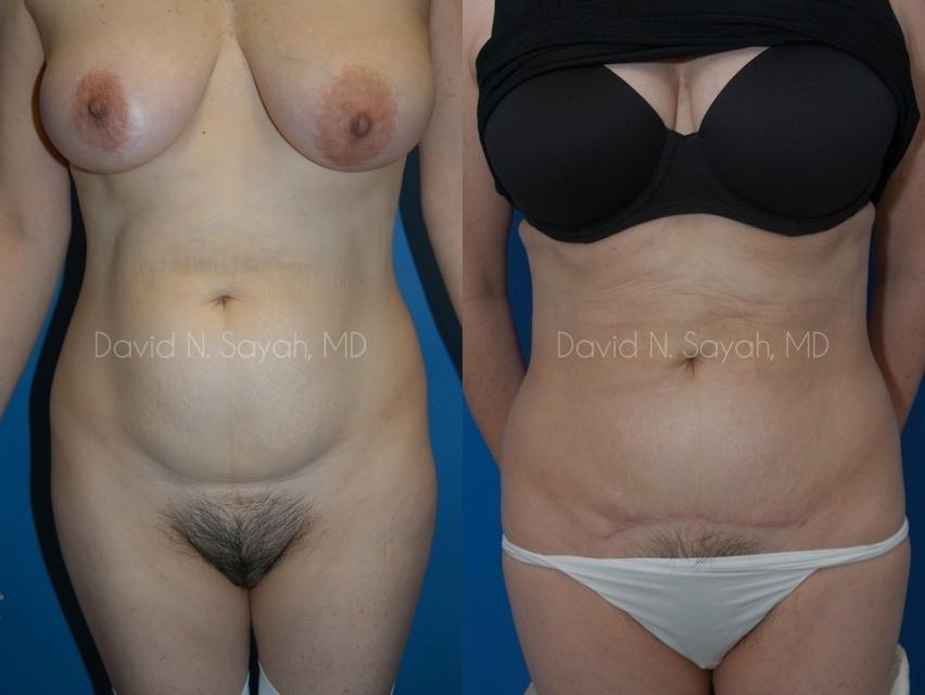 Tummy Tuck Before and After | Sayah Institute