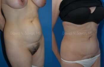 Tummy Tuck Before and After | Sayah Institute