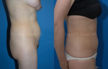 Tummy Tuck Before and After | Sayah Institute