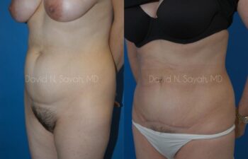 Tummy Tuck Before and After | Sayah Institute